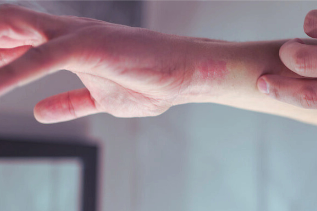 טיפול באטופיק דרמטיטיס