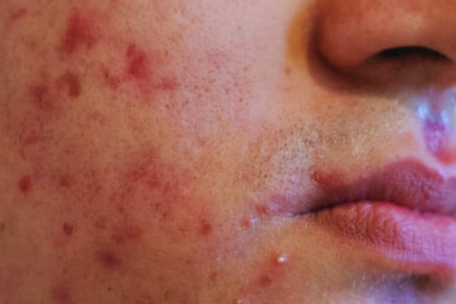 אקנה ופוסט אקנה