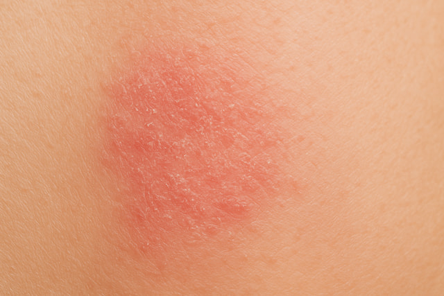 אטופיק דרמטיטיס